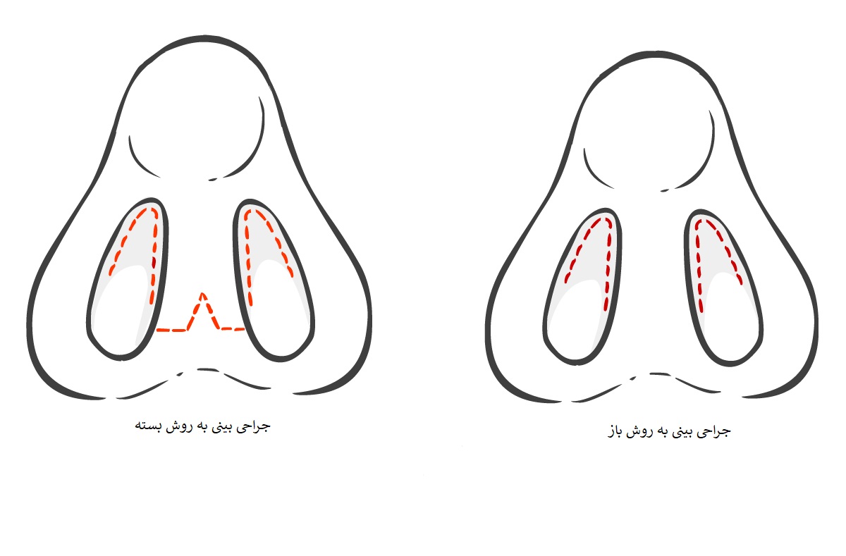 انواع روش های جراحی بینی