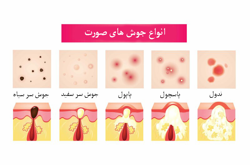 انواع جوش صورت