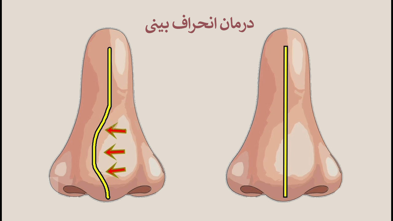 درمان انحراف بینی