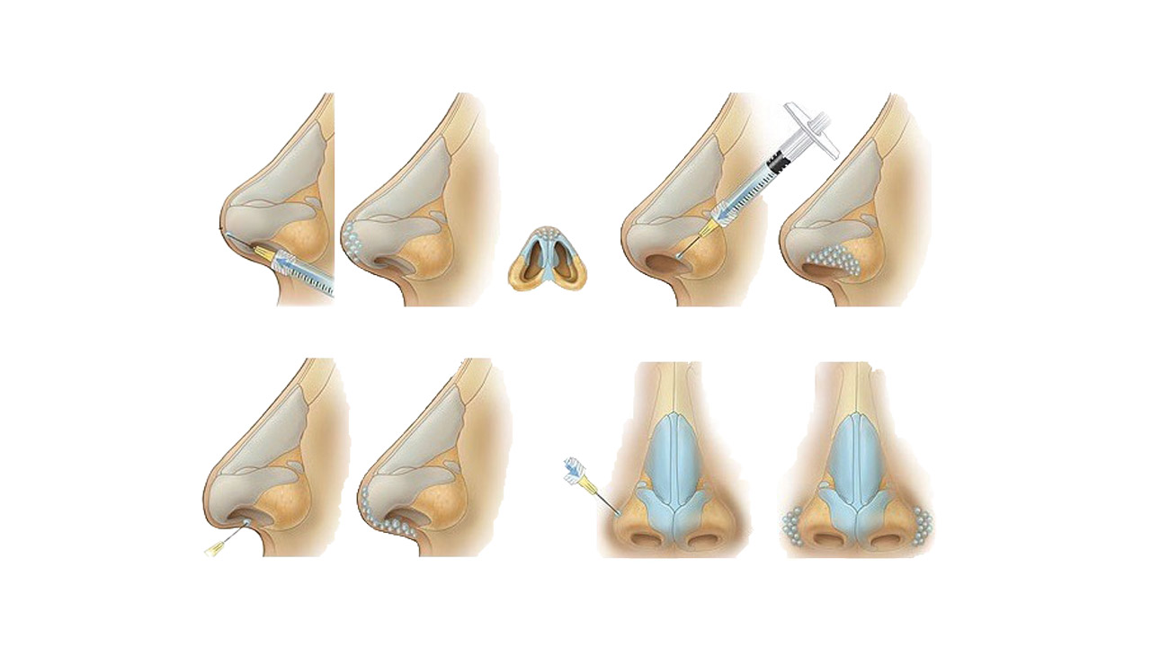مراحل تزریق فیلر بینی