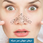 درمان جوش سر سیاه