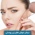 درمان جوش های زیر پوستی