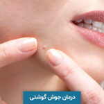 درمان جوش گوشتی