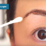 عفونت بعد از کاشت ابرو