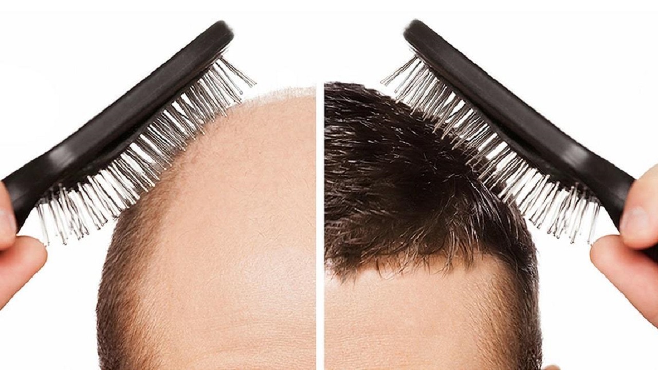 قبل و بعد کاشت مو